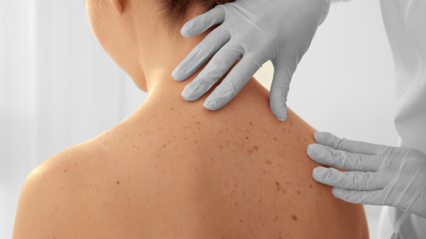 Under Euromelanoma-veckan erbjuds möjligheten att träffa en hudspecialist som kan undersöka eventuella hudförändringar, helt utan remisskrav. Foto: Shutterstock